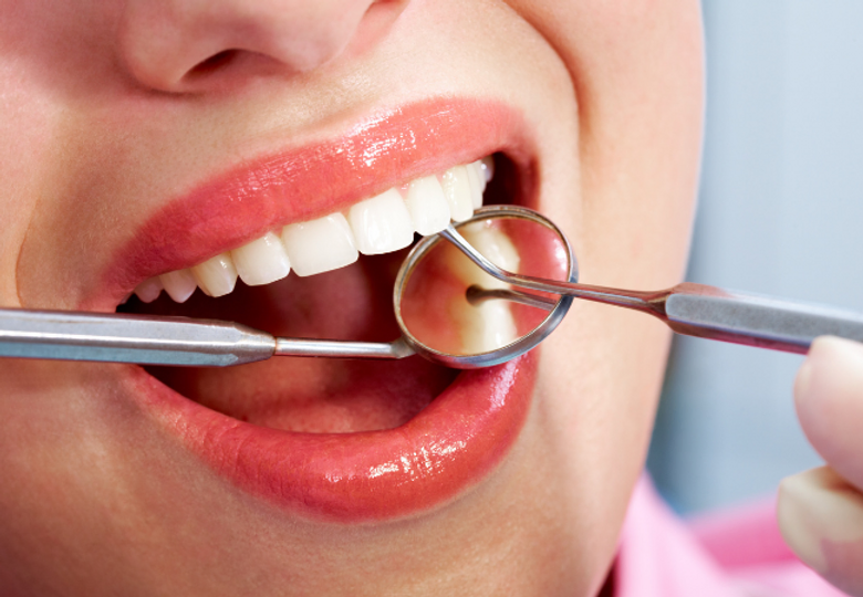 can you whiten composite bonding?