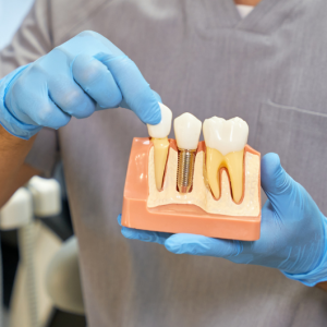 Dental implant demonstration